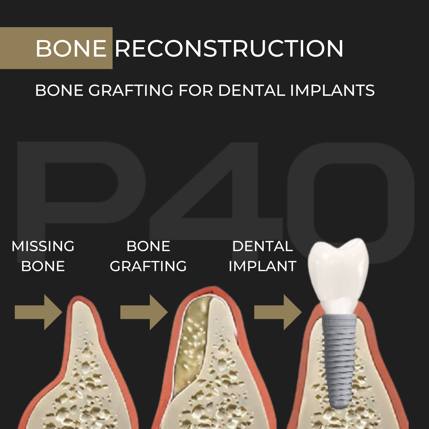 Bone Grafting for Dental Implants Graphic